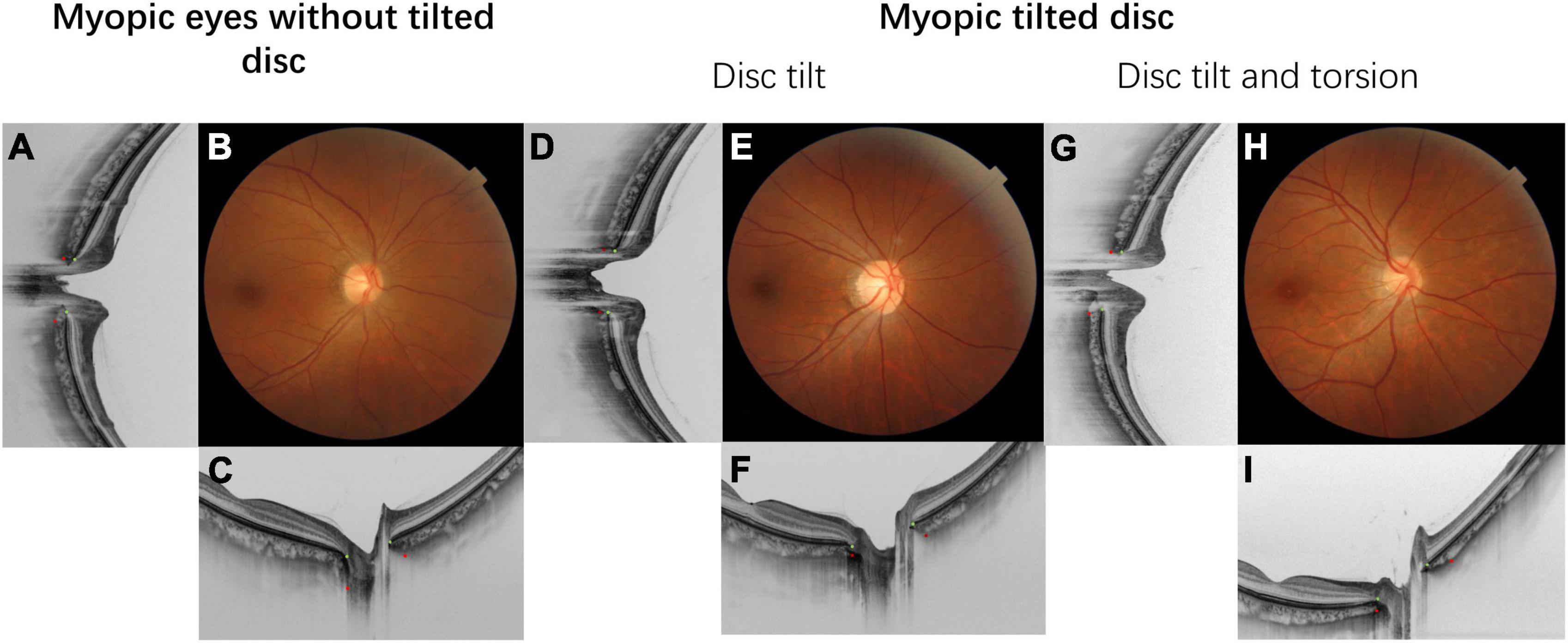 Myopic tilted disc: Mechanism, clinical significance, and public health implication